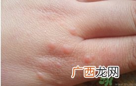 手上长小疙瘩很痒怎么回事?手上长小疙瘩怎么办