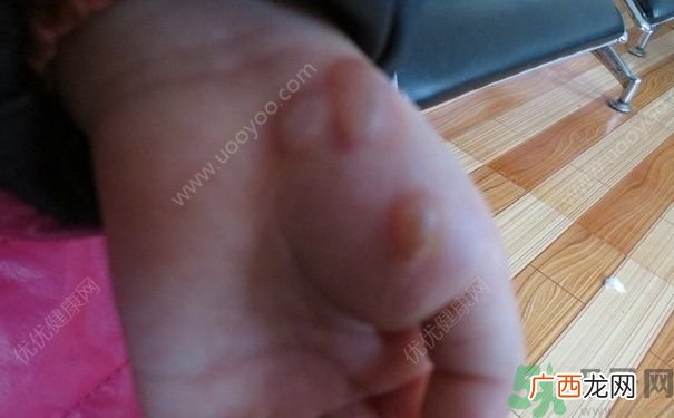15岁还会得手足口病吗？手足口病的症状有哪些？