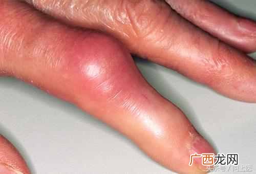 如何预防痛风发作 痛风吃什么药