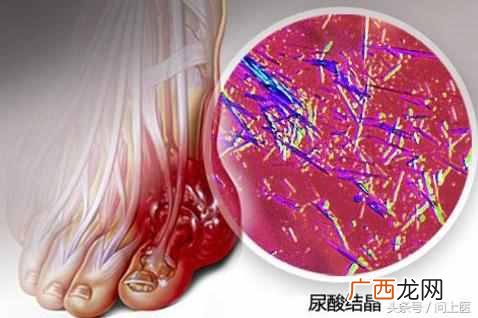 如何预防痛风发作 痛风吃什么药
