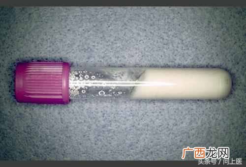 如何预防痛风发作 痛风吃什么药