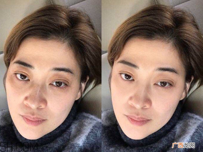 黑眼圈怎么去除既简单有容易 看类型与程度