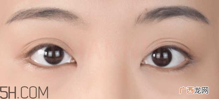 黑眼圈怎么去除既简单有容易 看类型与程度