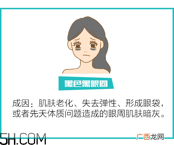 黑眼圈怎么去除既简单有容易 看类型与程度
