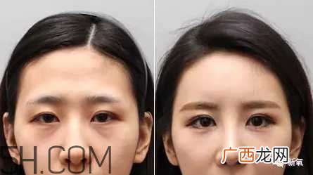 黑眼圈怎么去除既简单有容易 看类型与程度