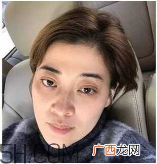 黑眼圈怎么去除既简单有容易 看类型与程度