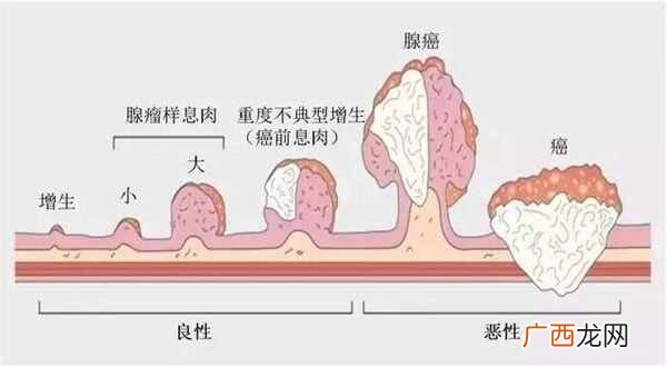 结节有哪些 结节是什么