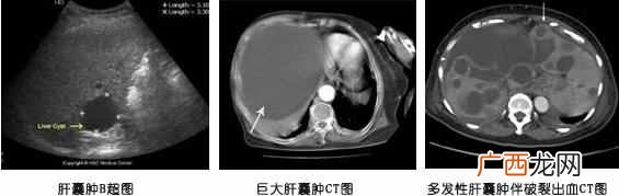 结节有哪些 结节是什么