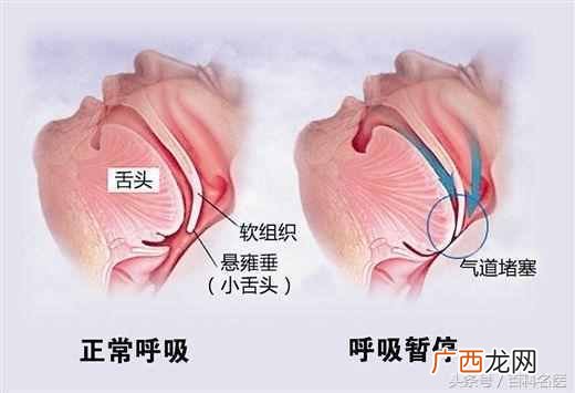 打呼噜是什么原因（打呼噜是什么病，不能大意