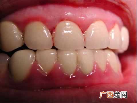 快速消炎的好方法推荐 牙龈肿痛吃什么药