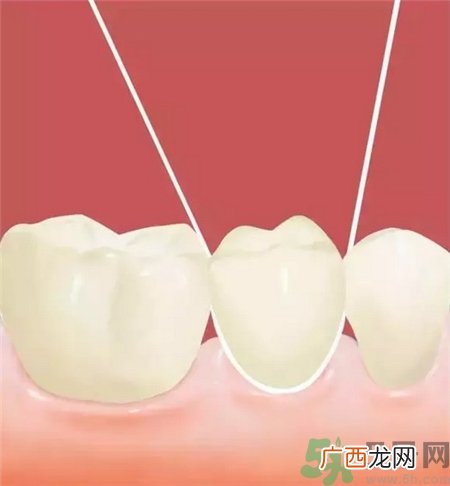 牙线会使牙缝变大吗?牙线会让牙缝变大吗?
