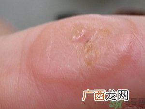 手上长水泡是什么原因?手上长水泡很痒怎么办?