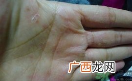 手上长水泡是什么原因?手上长水泡很痒怎么办?