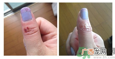 液体创可贴怎么撕下来?液体创可贴怎么去除?