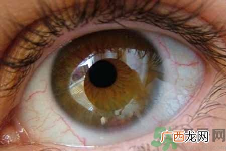 干眼症的治疗方法是什么?如何预防干眼症?