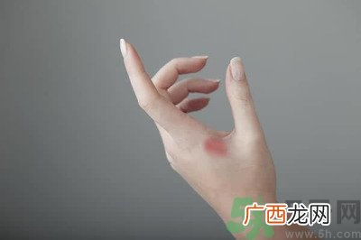 手被烫红了怎么办？手被烫了怎么止痛？