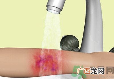 手被烫红了怎么办？手被烫了怎么止痛？