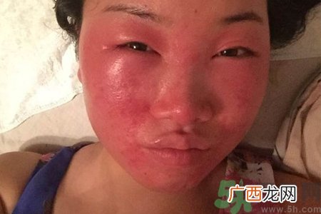 脸过敏发红痒怎么办？脸过敏发红痒擦什么药好？