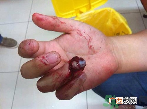 手被门夹了有淤血怎么办?手被门夹了怎么缓解疼痛
