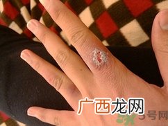 冻疮破了怎么办?冻疮初期怎么治