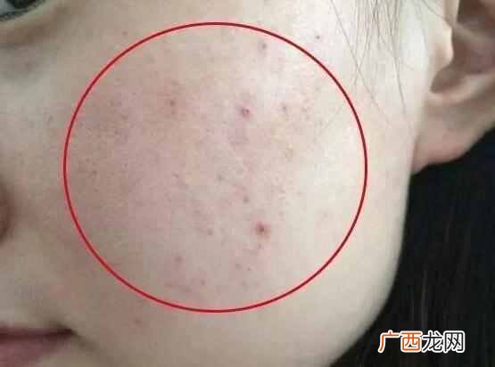 护肤妙招，除螨就是这么简单，赶紧试试吧