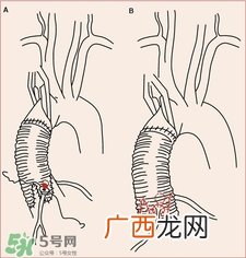 人造血管可以用多久?人造血管的护理