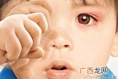 该怎么治疗红眼病 得了红眼病怎么办
