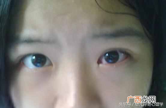 该怎么治疗红眼病 得了红眼病怎么办