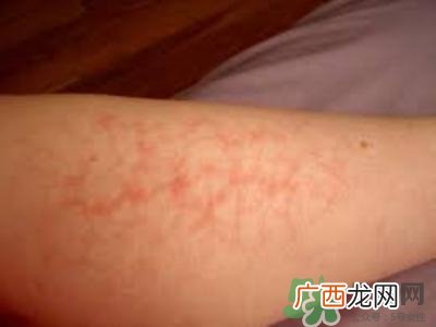 腿上有血丝是怎么回事?腿上有血丝怎么消除