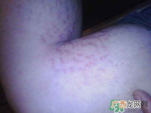 腿上有血丝是怎么回事?腿上有血丝怎么消除