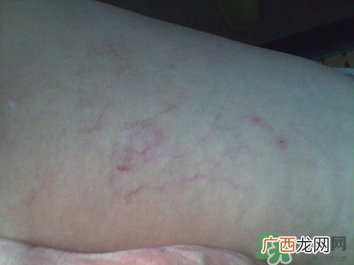 腿上有血丝是怎么回事?腿上有血丝怎么消除