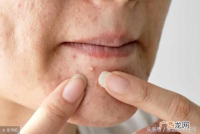 皮肤专家教你预防长痘痘 长痘怎么办