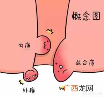 为什么会得痔疮，你知道吗 怎么预防痔疮