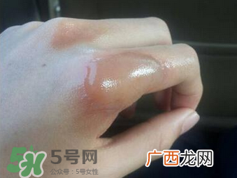 烫伤可以用牙膏吗？烫伤用牙膏管用吗？