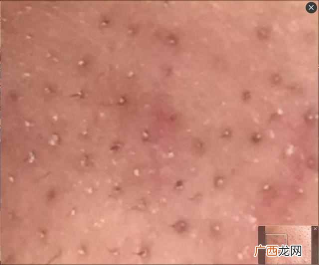 脸上长粉刺怎么办（教你怎么预防粉刺反复出现
