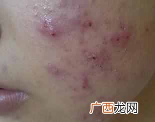 痤疮怎么治疗最好（皮肤科医生告诉你解决方案