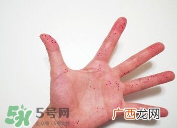 切辣椒后手很辣怎么办？切辣椒后手很辣多久能好