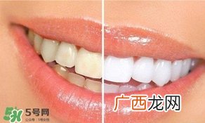 牙周炎好治吗?牙周炎好不好治