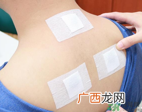 三伏贴贴在什么位置?三伏贴贴哪里?