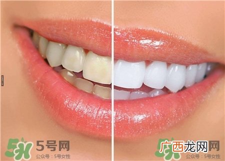 牙贴有用吗?牙贴副作用是什么?