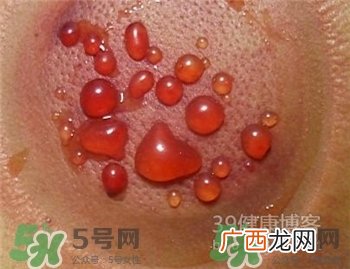 拔火罐有水泡是为什么?水泡要怎么处理?