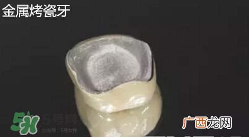 烤瓷牙和全瓷牙有什么区别?烤瓷牙和全瓷牙的区别