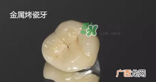 烤瓷牙和全瓷牙有什么区别?烤瓷牙和全瓷牙的区别