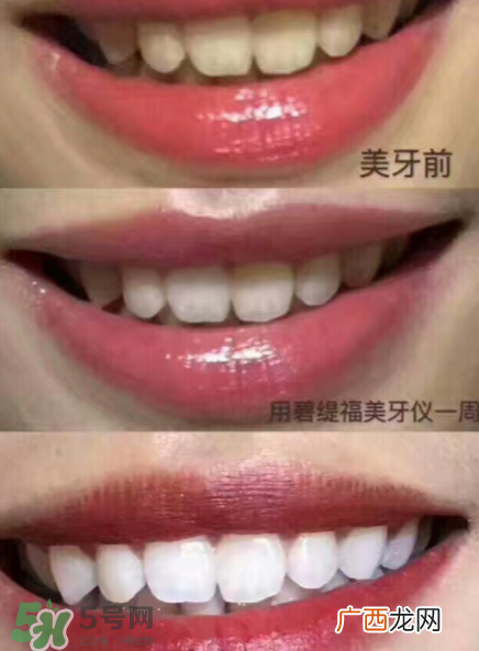 美牙仪能用水洗吗？美牙仪能用多久？