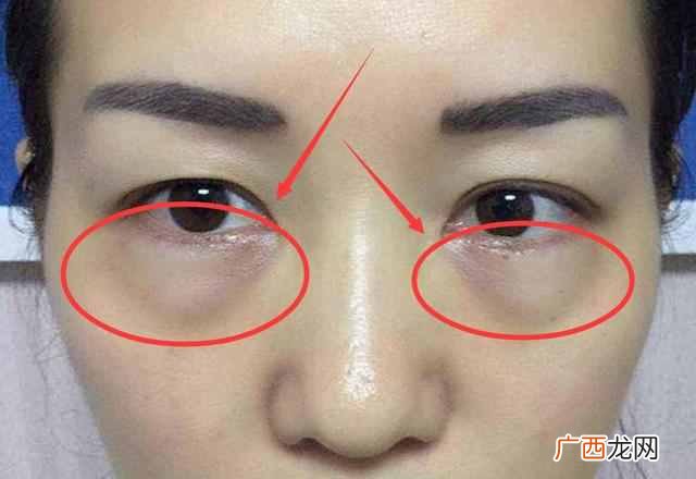 怎么样去除眼袋？除了手术最有效的方法