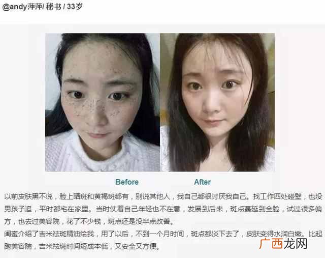 怎么祛斑最有效？大家都在用的方法，你也试试
