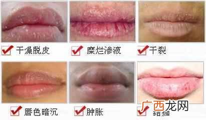 唇炎怎么治疗最好？五分钟帮你解决困扰