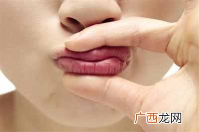 唇炎怎么治疗最好？五分钟帮你解决困扰