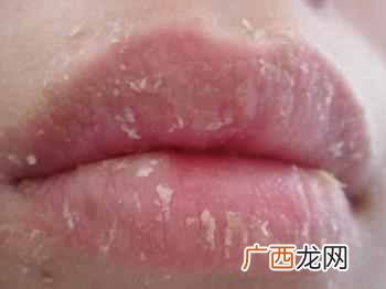 唇炎怎么治疗最好？五分钟帮你解决困扰