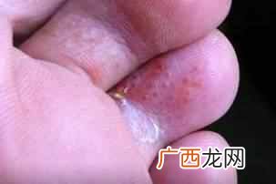 香港脚怎么治才能根除？教你一招彻底治疗
